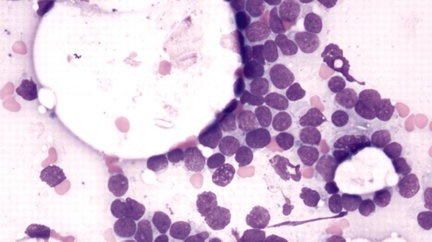 Leukemia T Cells