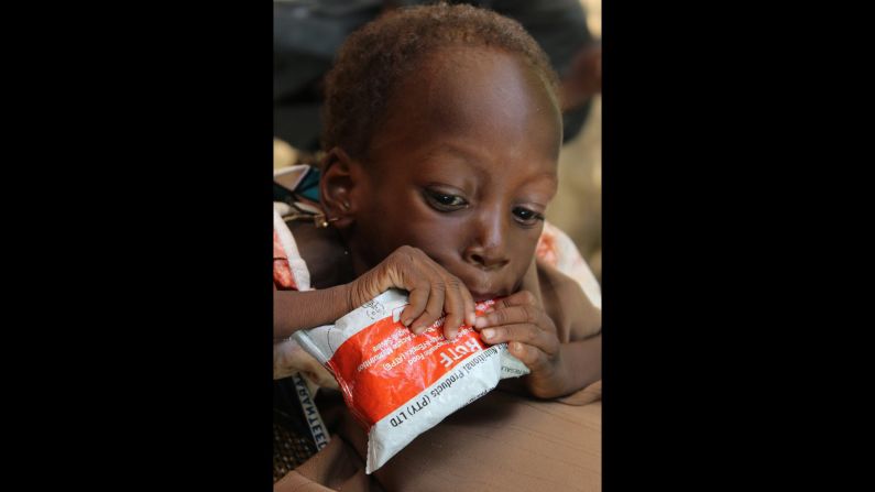 A malnourished child eats therapeutic food in Nigeria as part of an appetite test, an important step in making sure a child is willing and able to eat in order to recover.