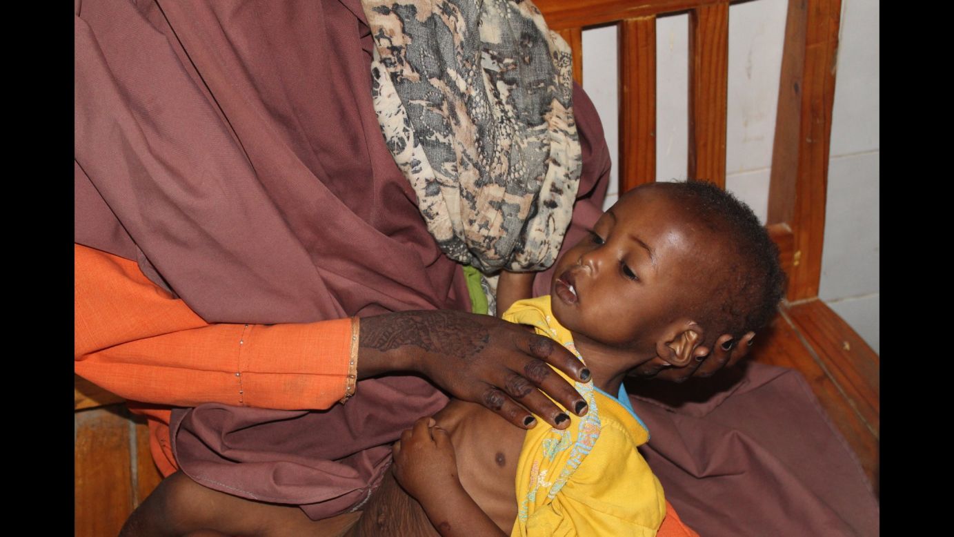 A mother in Somalia holds her severely malnourished child. The woman almost lost her third child to starvation before International Medical Corps stepped in and brought the child to a nearby hospital.