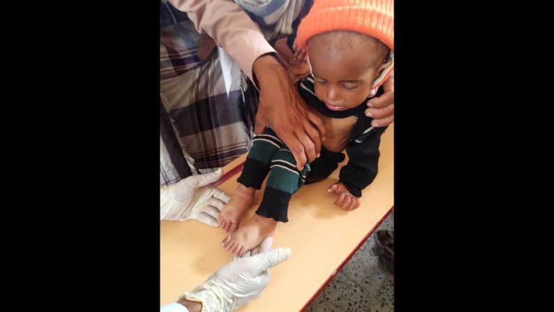 Twenty-month-old Musa is assessed for malnutrition in Yemen. He has since fully recovered with the help of International Medical Corps local First Responders.