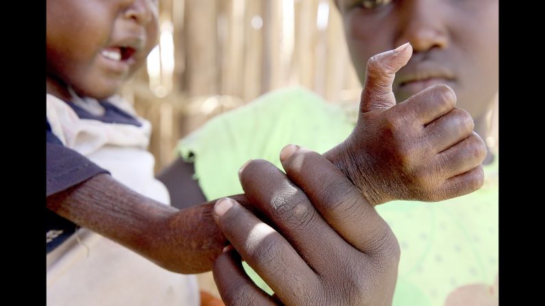 Ten-year-old Nancy Ero shows her little sister's arm at a Save the Children health center in Kenya. <br />