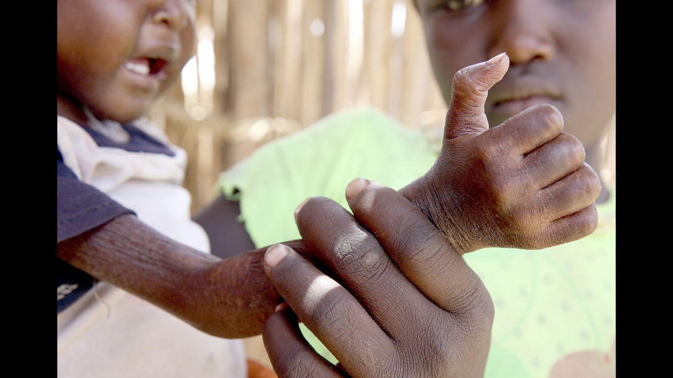 Ten-year-old Nancy Ero shows her little sister's arm at a Save the Children health center in Kenya. <br />