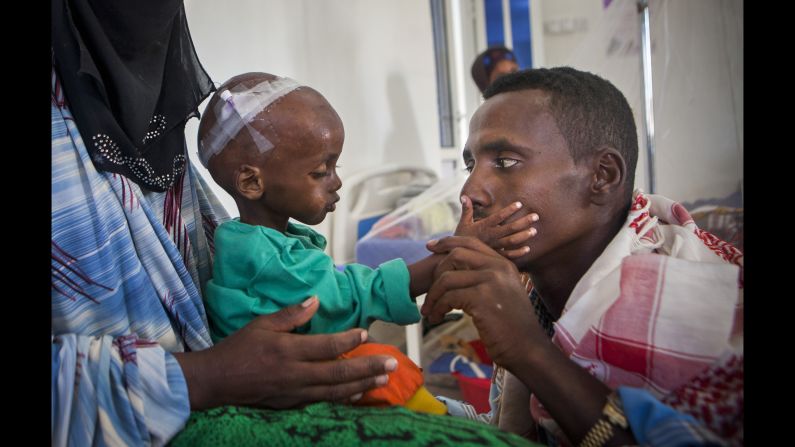 A 15-month-old boy suffering from malnutrition and related complications was brought to a hospital in Somalia by his parents.