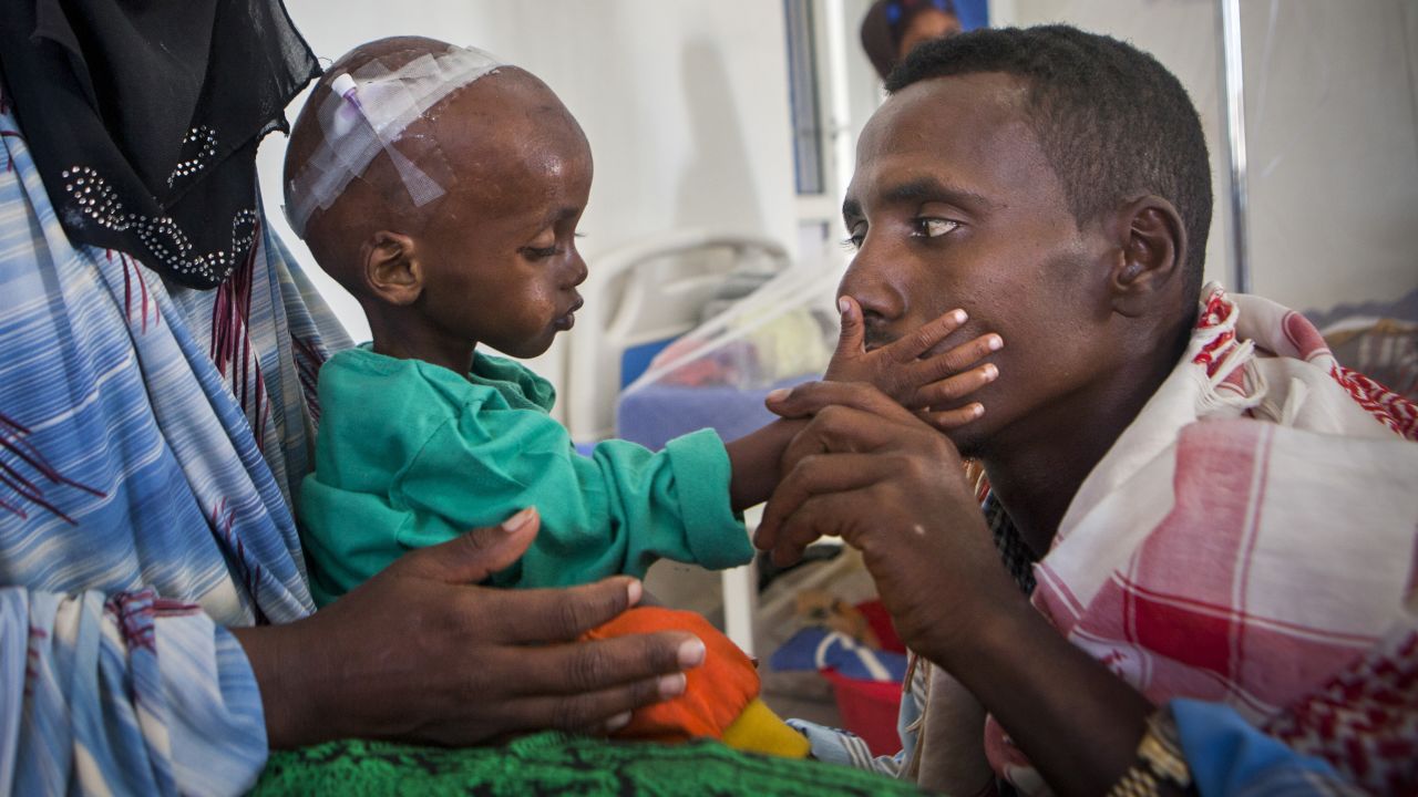 A 15-month old boy was brought to a Somalia hospital by his mother Laylo and father Mohamed, suffering from malnutrition and other related complications. 

