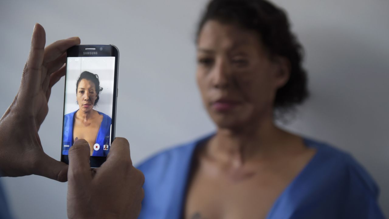 An acid attack survivor stands for a photo in a surgeon's office in Bogota, Colombia. 