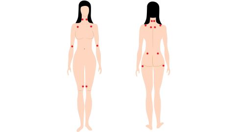 Tender trigger points of fibromyalgia, no longer used for a definitative diagnosis.