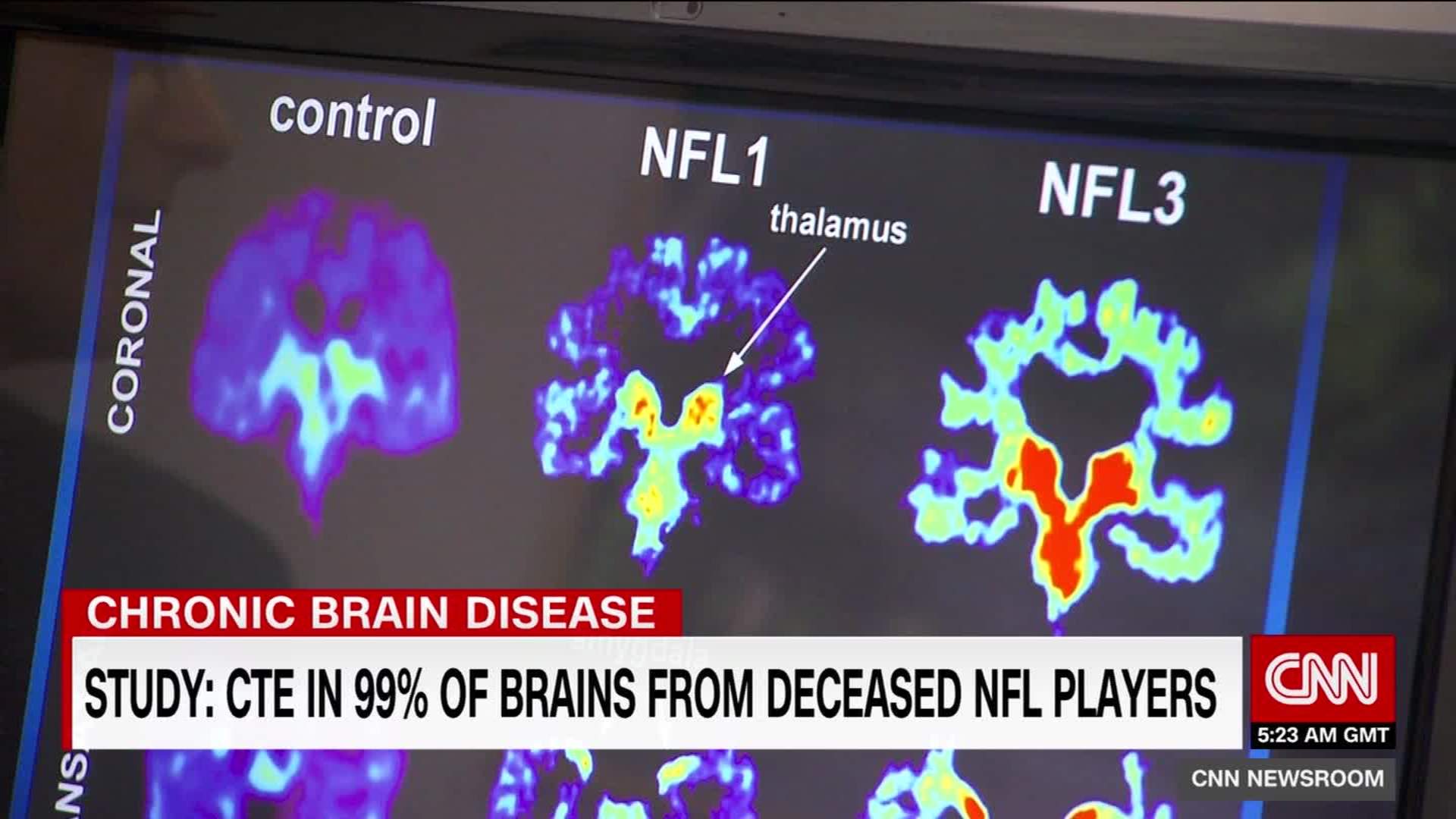 Junior Seau Suffered from Traumatic Brain Disease Known as CTE, News,  Scores, Highlights, Stats, and Rumors