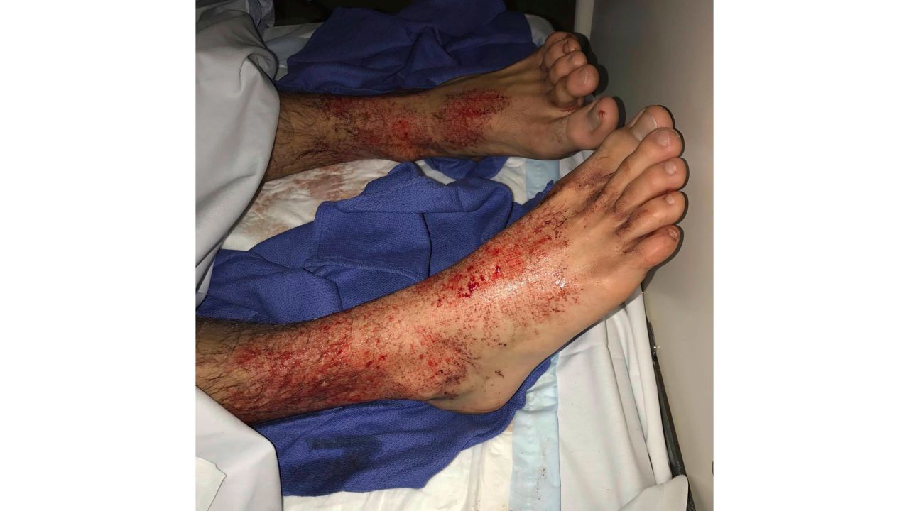 Sam Kanizay's feet were covered in what appeared to be thousands of bleeding pinholes.