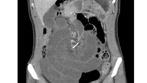 A piece of a dental wire perforated several spots in a woman's small intestine.