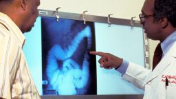390487 08: (FILE PHOTO) A doctor goes over a patient''s x-ray, screening for colon cancer. There is no single cause of colon cancer. Cancer of the colon and rectum accounts for 15% of cancer deaths. (Photo by American Cancer Society/Getty Images)