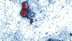 Cyclosporiasis is an intestinal infection caused by the cyclospora cayetanensis parasite.  It's seen here on a stool sample through a microscope on a slide. The parasite is too small to see without the use of a microscope. Illness is caused by consuming food or drink that contains the parasite and usually takes about a week to make a person sick.