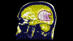 Mri T1. Glioblastoma. A Nodulus Of The Cerebellum Protrudes Into The Cystic Cavity. (Photo By BSIP/UIG Via Getty Images)