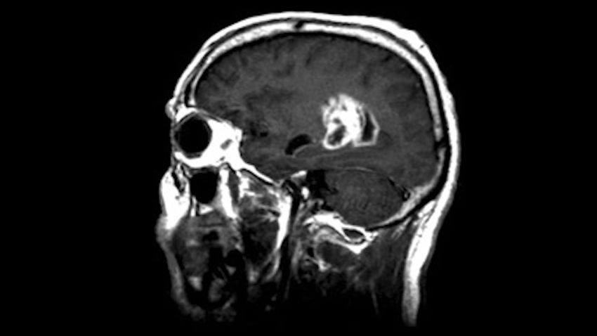 glioblastoma 1