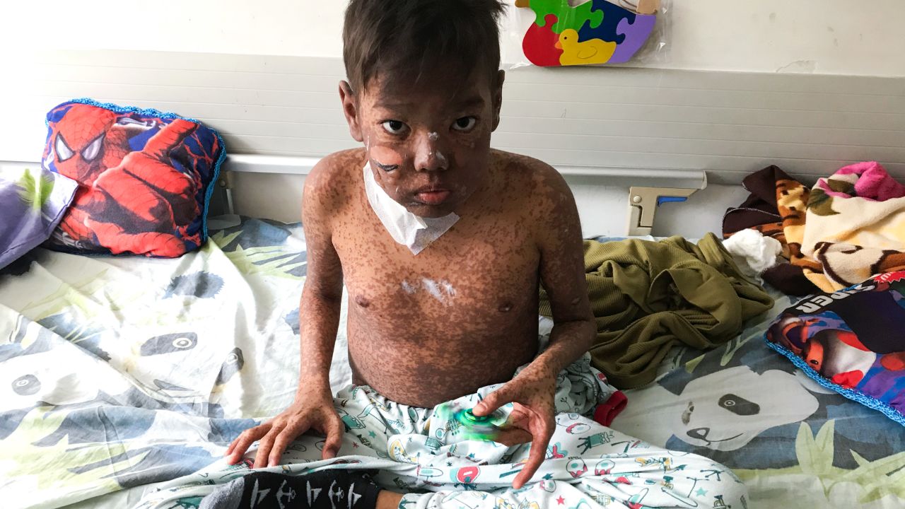 Deivis Perez's 14-year-old body shrank to that of younger child.