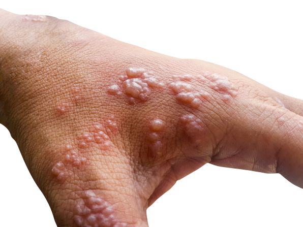 University of Kent postgraduate researcher Tom Kupfer has studied the connection between trypophobia and infectious disease. He points to leprosy, smallpox and measles, which show up as small clusters of shapes on the skin.<br /><br />"Smallpox alone killed millions of millions of people, so if a human ancestor was predisposed to attend to those bumps, to dislike them and stay away from them," said Kupfer, "that could provide a survival advantage."