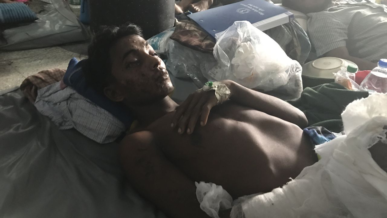 Yousuf Nabi's facial injuries were likely caused by the gunpowder from a landmine blast, say doctors.