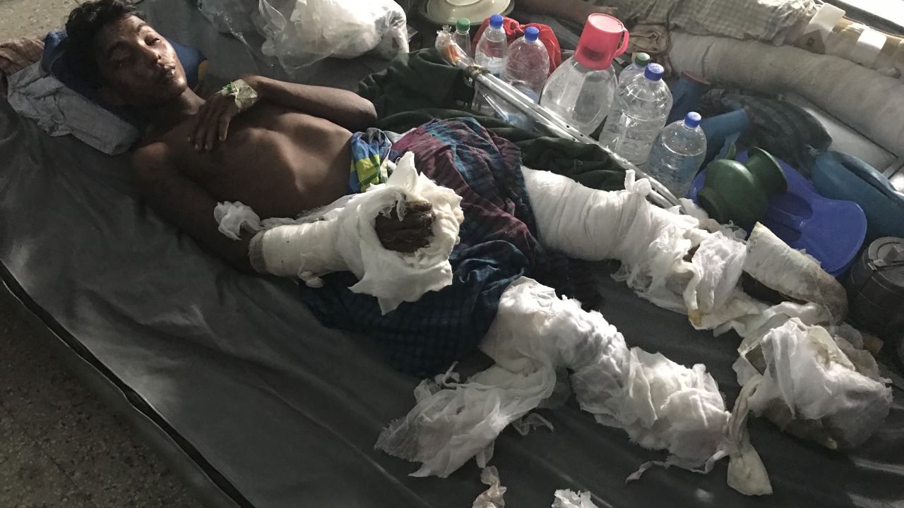 Rohingya refugee Yousuf Nabi's legs were both partially blown off when he stepped on a landmine trying to escape from Myanmar.