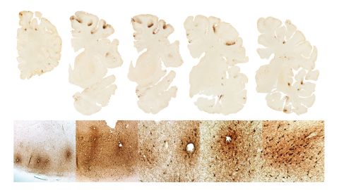 This graphic from the Boston University CTE Center shows the classic features of CTE in the brain of Aaron Hernandez. There is severe deposition of tau protein in the frontal lobes of the brain (top row). The bottom row shows microscopic deposition of tau protein in nerve cells around small blood vessels, a unique feature of CTE.