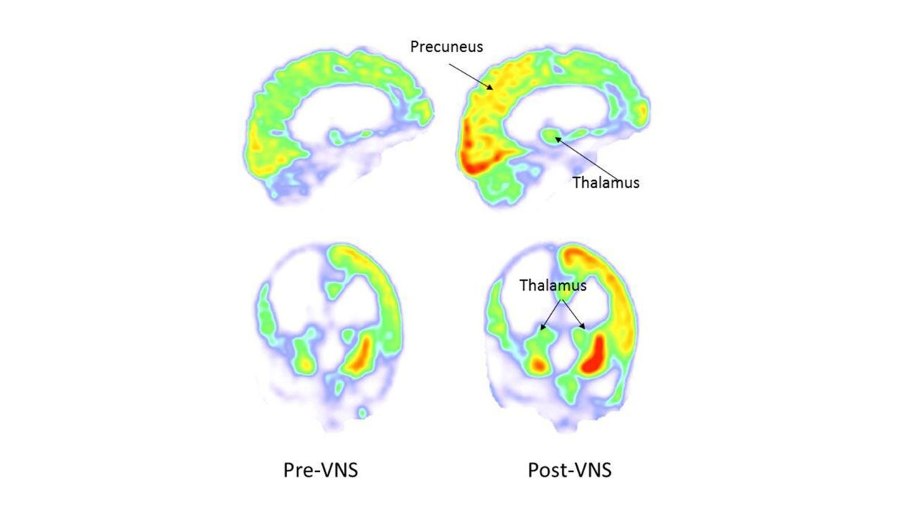 PET scan images of the brain show areas of the brain where glucose metabolism, necessary for mental function, increased following vagus nerve stimulation.