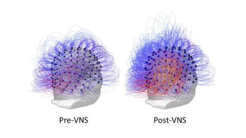 EEG images show an increase of information sharing across the brain, as evidenced by the yellow and orange colors, following vagus nerve stimulation.