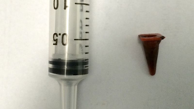 Mans lung tumor turns out to be a toy