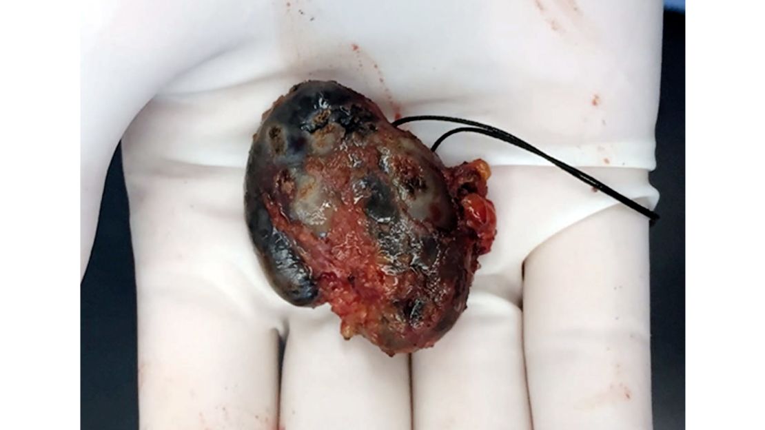 The lymph node that was removed from the woman's armpit.