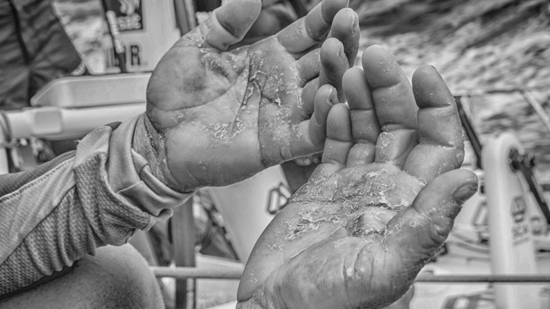 Battered hands after eight days of the Volvo Ocean Race in 2015.