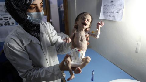 An infant suffering from severe malnutrition in Eastern Ghouta.