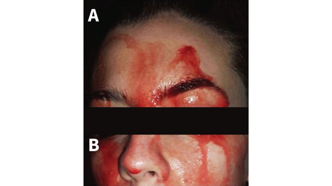 A young woman was sweating blood from her face and palms, a recent case study said.