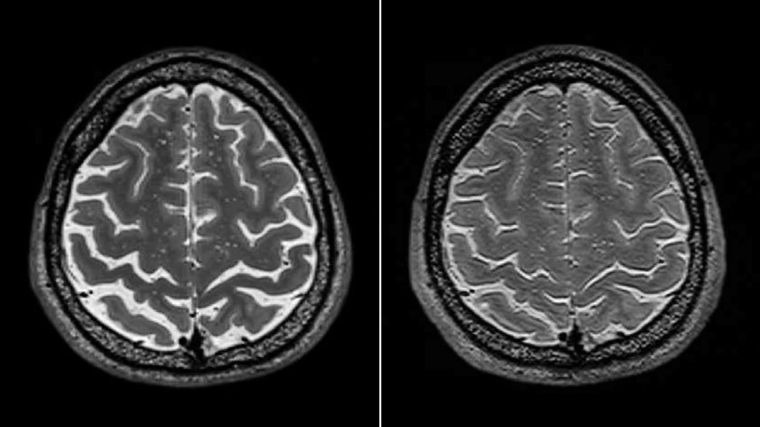 A long-term spaceflight astronaut's brain before, left, and after a mission.