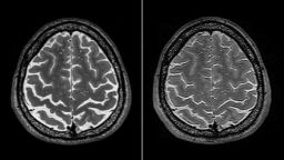 Axial T2-weighted images of the brain obtained before (Panel A, left ) and after (Panel B, right)) this astronaut had undergone
long-duration spaceflight on the International Space Station (Participant 18). The astronaut presented with opticdisk
edema and the visual impairment and intracranial pressure syndrome after spaceflight. Crowding of the sulci
can be seen at the vertex. The gyrus (asterisk) is the precentral gyrus (primary motor cortex).