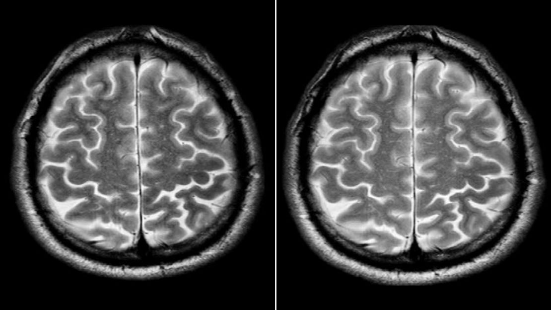 A short-term spaceflight astronaut's brain before, left, and after a mission. 