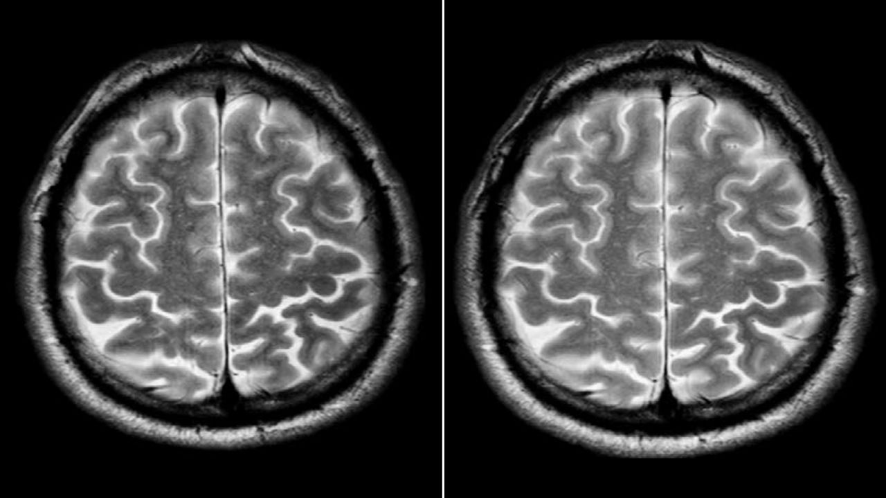 A short-term spaceflight astronaut's brain before, left, and after a mission. 