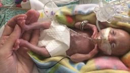 At three weeks old, Courtney Stensrud's daughter was just starting to open her eyes while she was in the NICU. She is pictured here, in 2014, with Stensrud's and her husband's wedding rings on their daughter's arm.