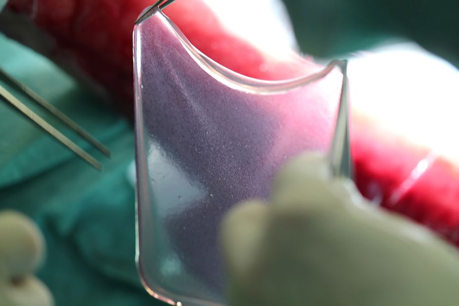 Using the boy's stem cells and transferring a healthy version of the gene that is normally defective in epidermolysis bullosa patients, the researchers were able to "grow" sheets of skin that could be transplanted onto his body.