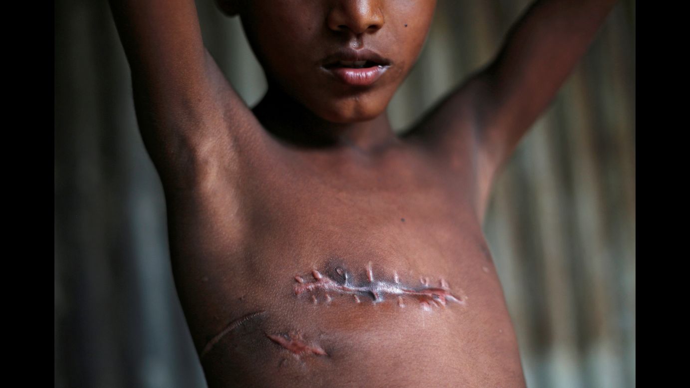 Mohammed Shoaib, a 7-year-old Rohingya refugee, shows his injured chest at a camp near Cox's Bazar, Bangladesh, on Sunday, November 5. Mohammed was shot while fleeing Myanmar. More than 500,000 Rohingya have fled Myanmar since late August, creating "a humanitarian and human rights nightmare," according to Antonio Guterres, secretary-general of the United Nations. <a href="http://www.cnn.com/interactive/2017/10/world/rohingya-refugees-cnnphotos/" target="_blank">Photos: A new life for the Rohingya</a>