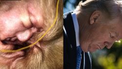 Donald Trump discovered in the ear of a beagle. Jeanne Moos reports on the weirdest Trump sighting ever.    Trump in Dog Ear    And you think YOU'VE had an earful of Donald Trump! A beagle in Britain named Chief actually has the image of Trump in his ear. Chief has been swinging his head and having ear problems so his owner waited till Chief was asleep (doesn't like his ears messed with) to take a photo of the inside to show to the vet. Lo and behold, there's trump. The owner didn't notice at first but her friend did and, once the photo was posted to Facebook, it went viral. Owner Jade Robinson started a crowdfunding page to try to get donations to pay for Chief's vet bills. So far they've got more than their goal. They're up to about $680. And the infection that apparently caused the Trump-like inflammation is being treated with antibiotic gel.  Will President trump disappear from the ear once the infection is gone? We interview the owner with Chief on her lap.