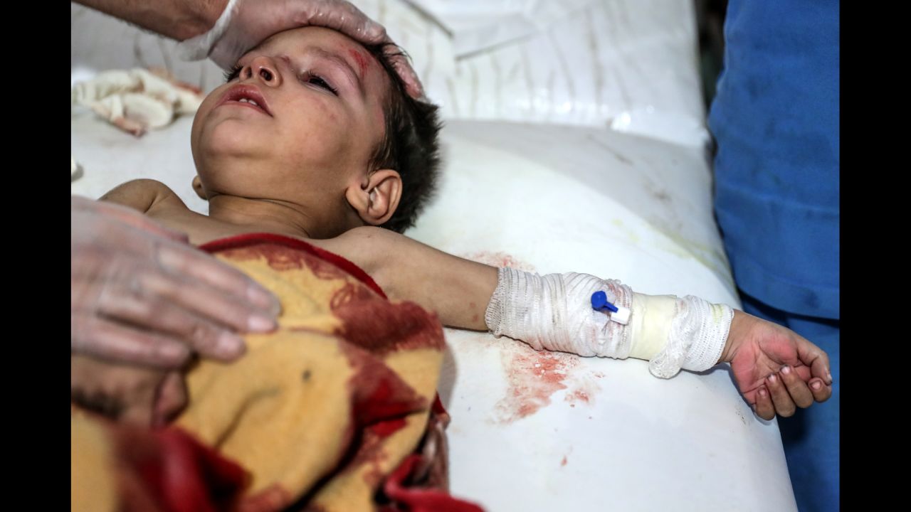 A boy receives medical attention after bombing in the rebel-held city of Douma, Syria, on Tuesday, November 14.