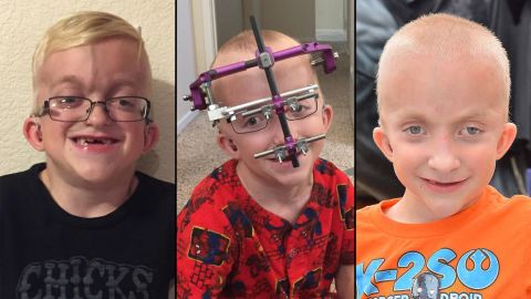 Shane Vysocky before, during and after his most recent surgery. He had to wear a halo device around his head that helped pull his jaw forward.