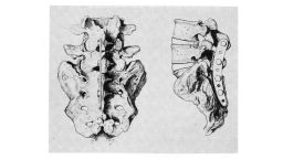 The Wilson plate used in JFK's second surgery to fuse his spine. It was removed months later.