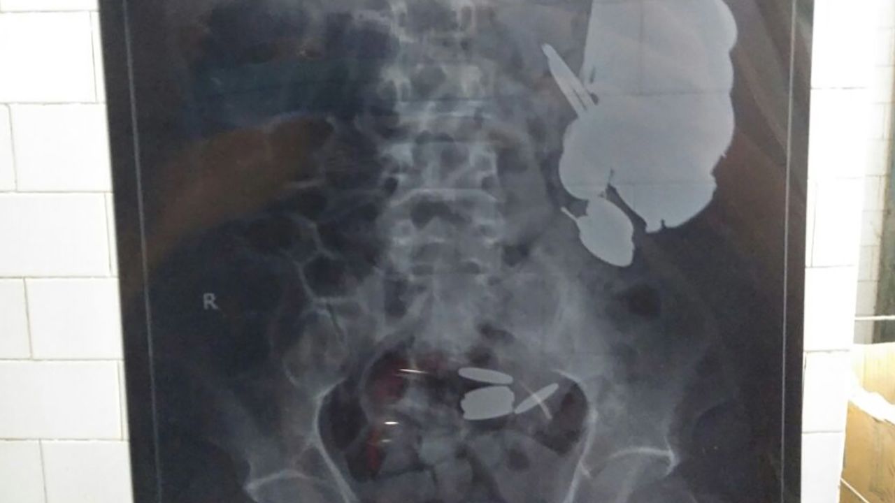 X-rays showed a number of foreign objects in the patient's stomach.