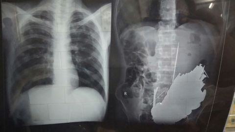 Another X-ray showing foreign objects in the patient's stomach.