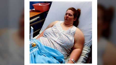 At age 18, Bartley had a vertical sleeve gastrectomy to reduce the size of her stomach.
