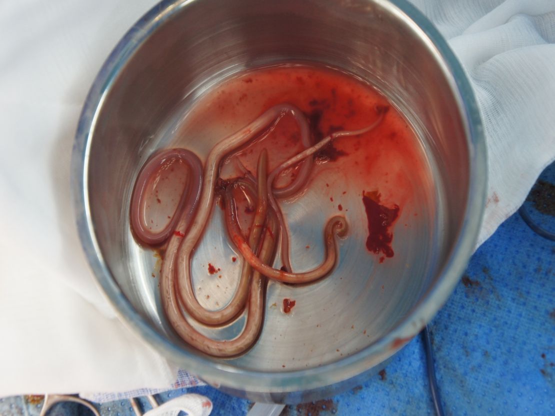 The worms Lee removed from Oh's body.