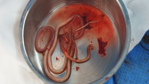 The worms Lee removed from Oh's body.  