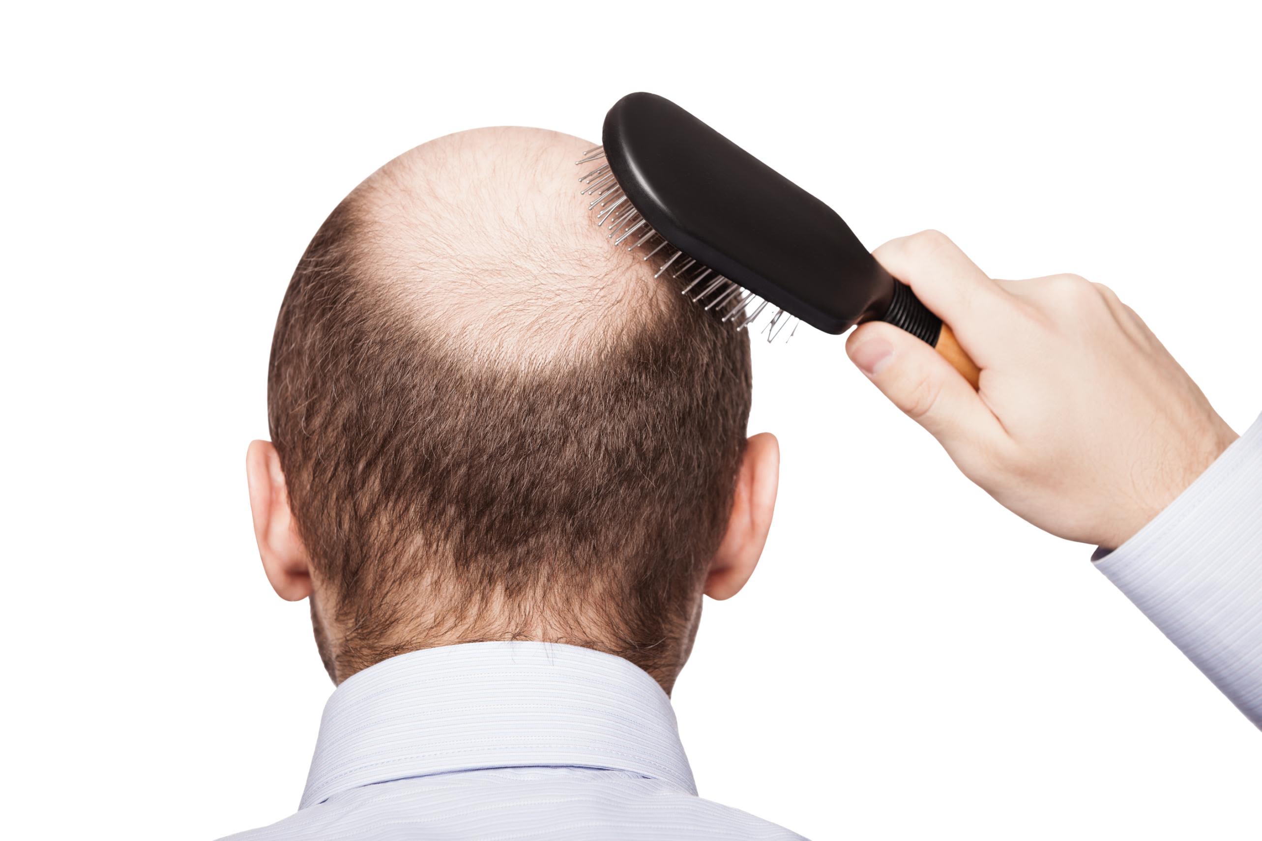 Side effects include ... a potential treatment for baldness | CNN