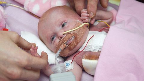 3-week-old Vanellope Hope Wilkins, who was born with her heart outside her body and survived surgery at Glenfield Hospital, in what is believed to be a UK first. 
