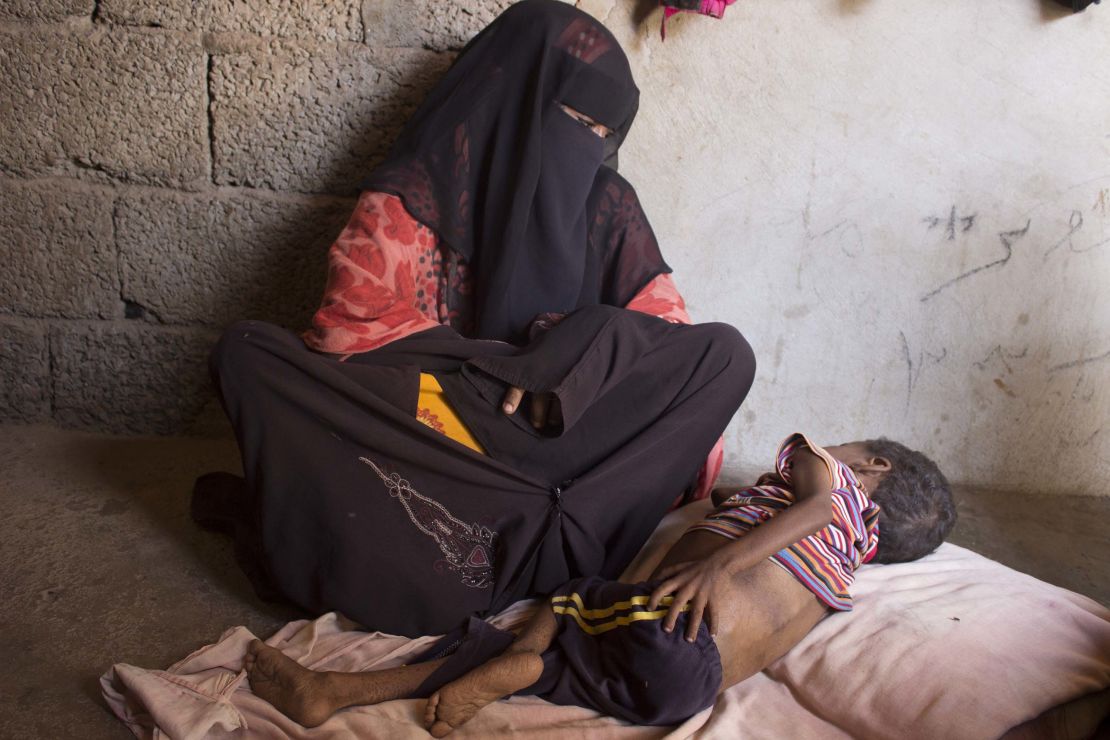 Five-year-old Ahmed Helmi lost his brother to malnourishment just two months ago.
