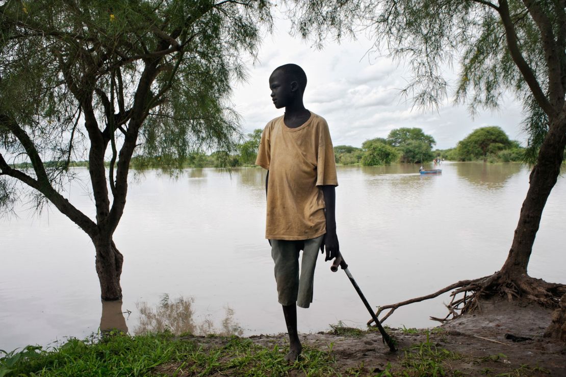 A snakebite victim with an amputated leg on the banks of the Pibor River in Jonglei State, South Sudan. 