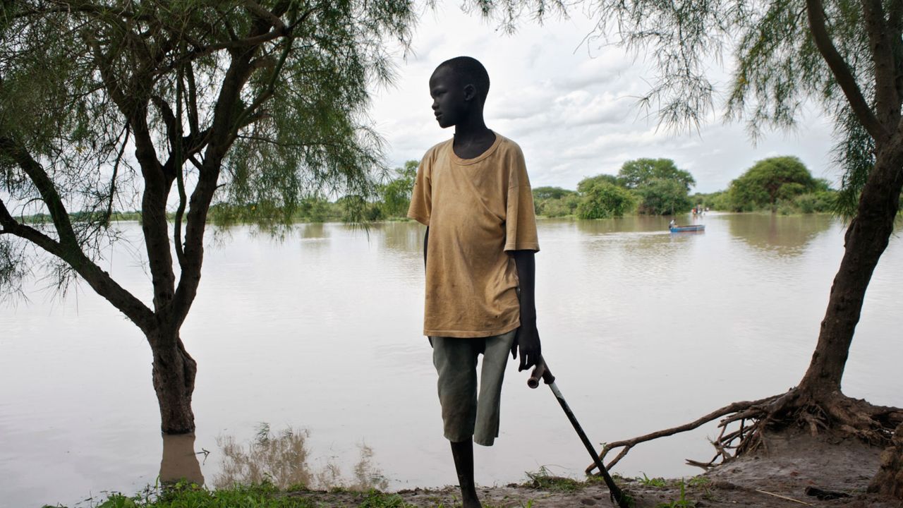 A snakebite victim with an amputated leg on the banks of the Pibor River in Jonglei State, South Sudan. 